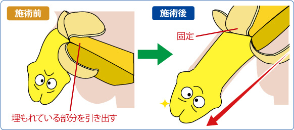 埋没陰茎牽引固定法