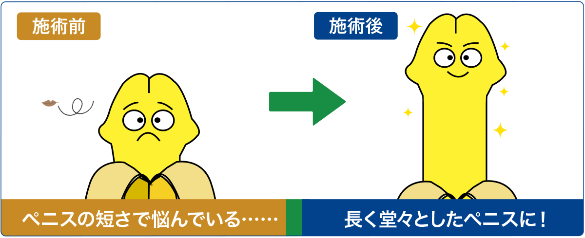 長茎術施術後イメージ:長くバランスのいい見た目に