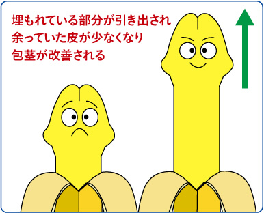 埋もれている部分が引き出され余っていた皮が少なくなり包茎が改善される
