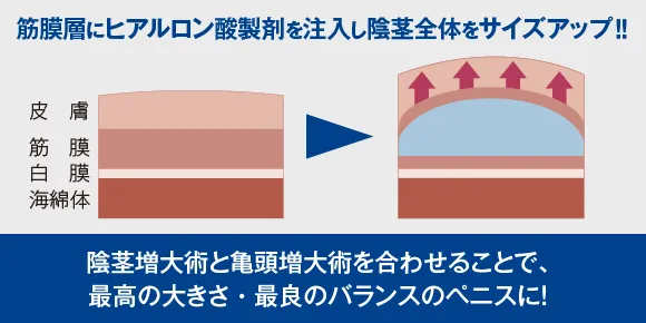 選べる施術法：薬剤注入法