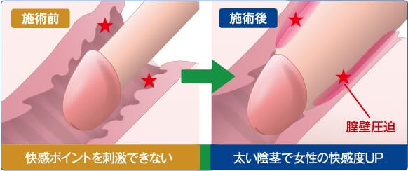 陰茎増大術:施術前と施術後のイメージ