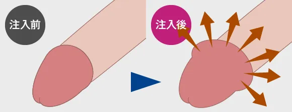 亀頭増大術：薬剤注入前・注入後