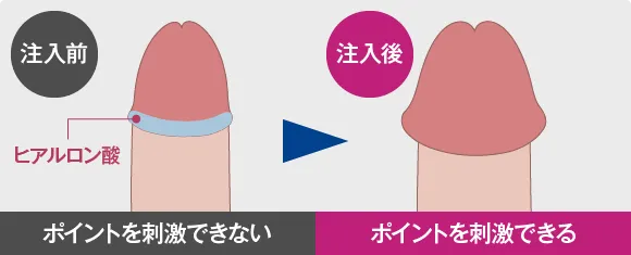 亀頭増大術施術後イメージ：大きくバランスのいい見た目に