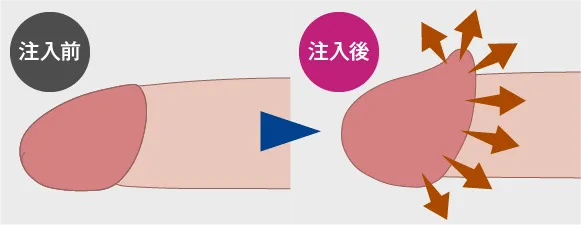 カリ高注入法：薬剤注入前→注入後