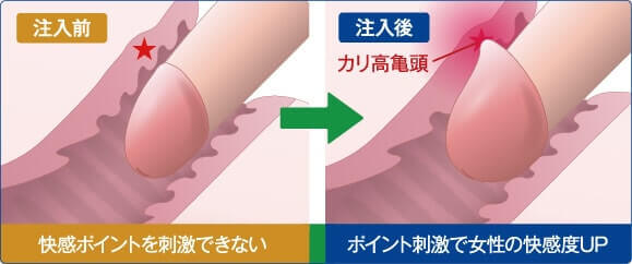 亀頭増大術:施術前と施術後のイメージ