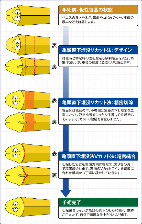 亀頭直下埋没Vカット法