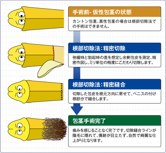 仮性包茎とは 包茎手術ならmsクリニック 新宿 横浜 名古屋 大阪