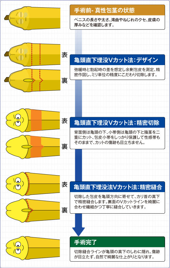 亀頭直下埋没Vカット法