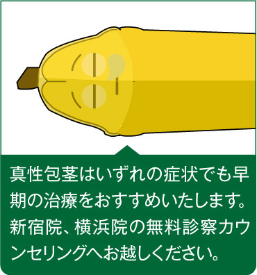 真性包茎はいずれの症状でも早期の治療をおすすめいたします。新宿、横浜の無料診察カウンセリングへお越しください。