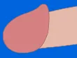 亀頭増大術のイラスト
